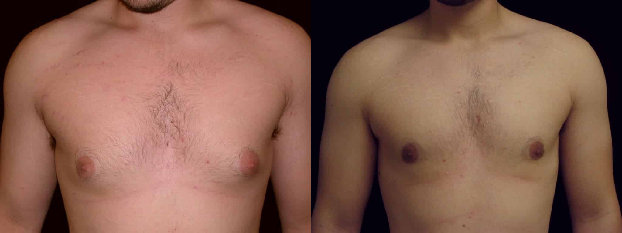 Gynecomastia Patient 13 Before & After