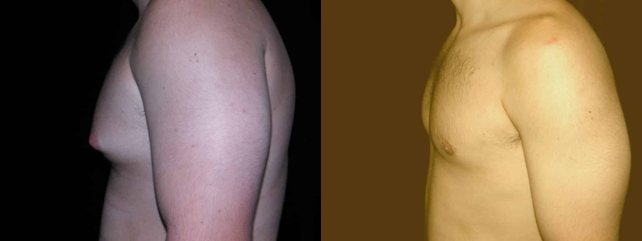 Gynecomastia Patient 12 Before & After Details