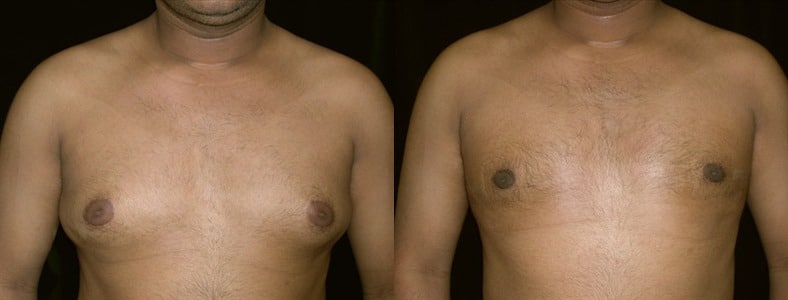 Gynecomastia Patient 17 Before & After