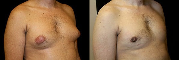 Gynecomastia Patient 8 Before & After Details