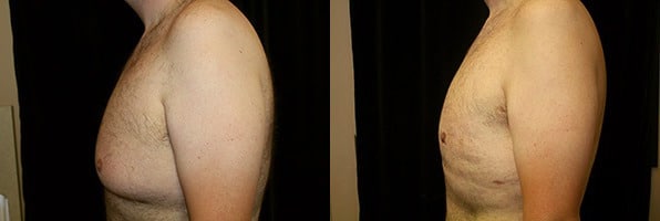 Gynecomastia Patient 20 Before & After Details