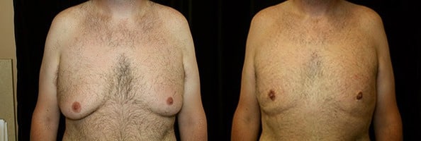 Gynecomastia Patient 20 Before & After