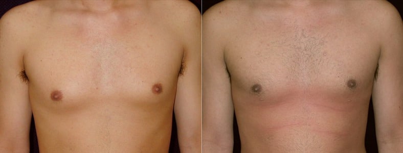 Gynecomastia Patient 9 Before & After