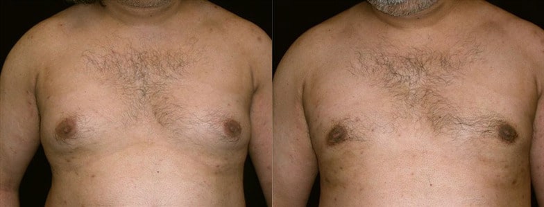 Gynecomastia Patient 6 Before & After