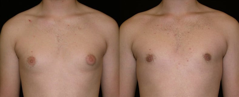 Gynecomastia Patient 6 Before & After