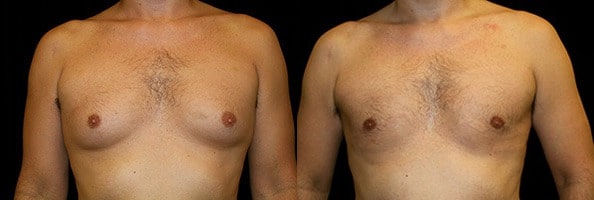 Gynecomastia Patient 10 Before & After