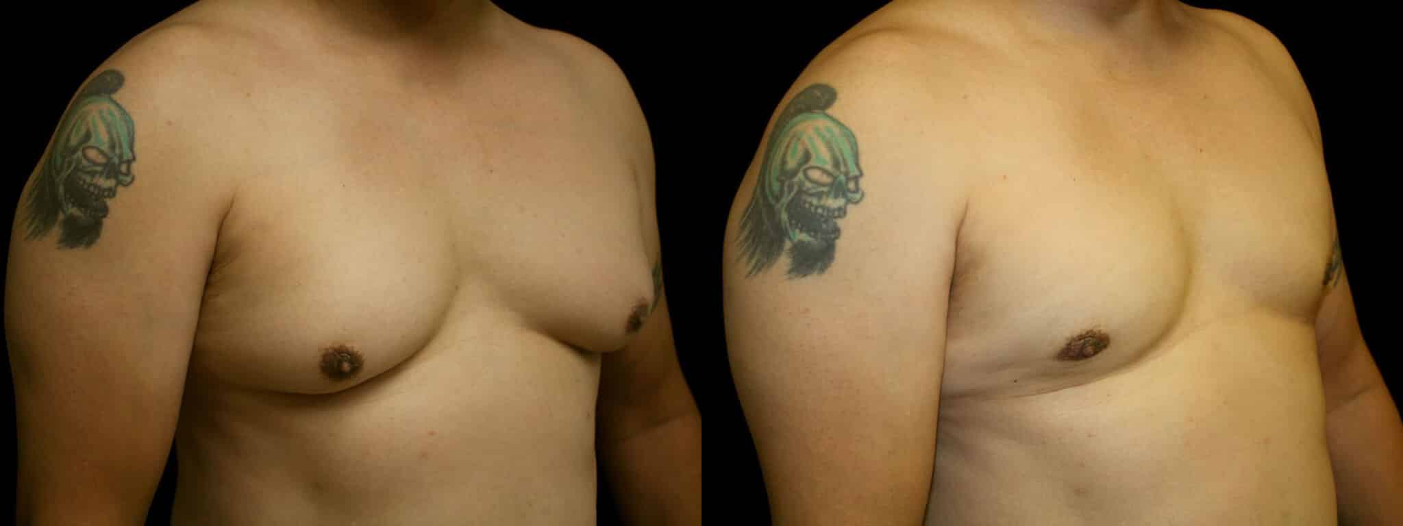 Gynecomastia Patient 6 Before & After Details