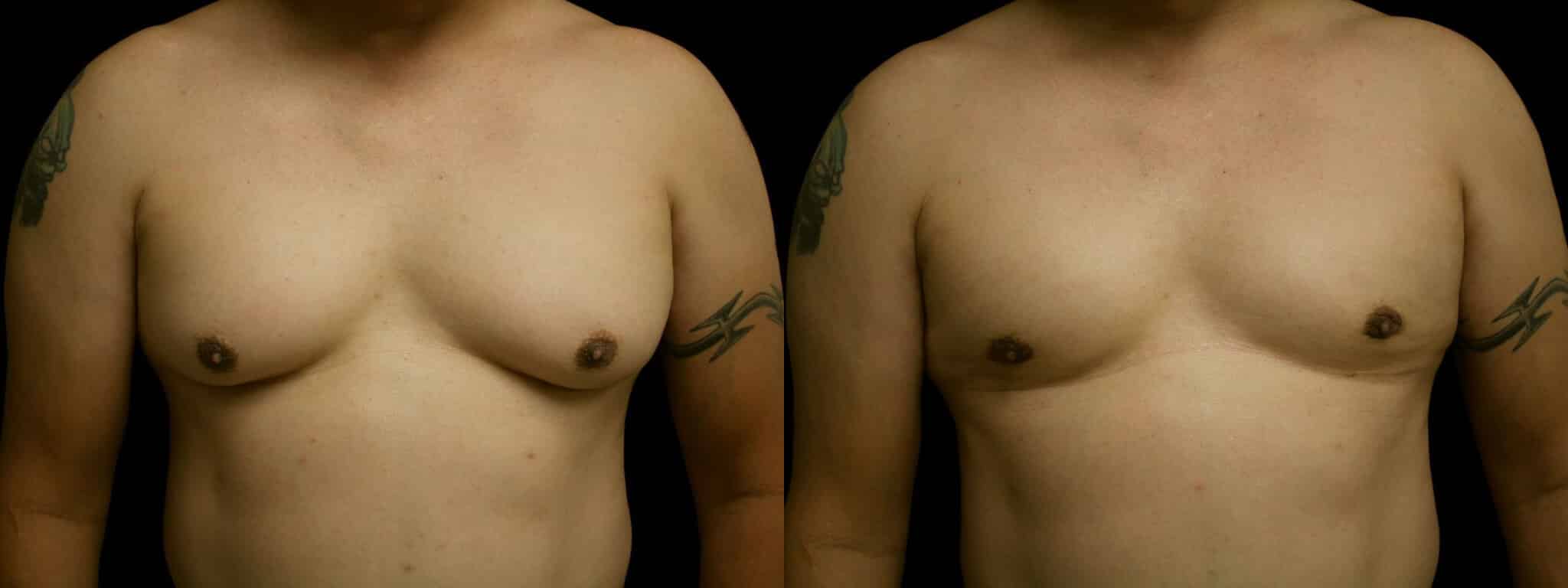 Gynecomastia Patient 6 Before & After