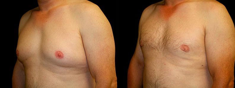 Gynecomastia Patient 5 Before & After Details