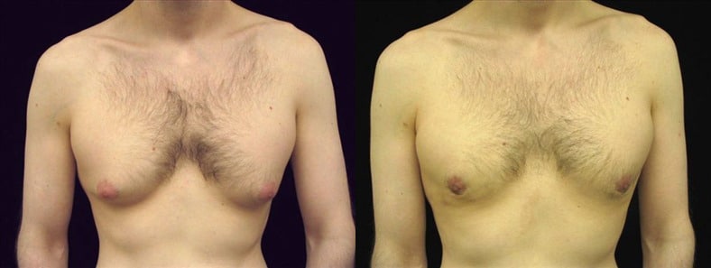 Gynecomastia Patient 2 Before & After