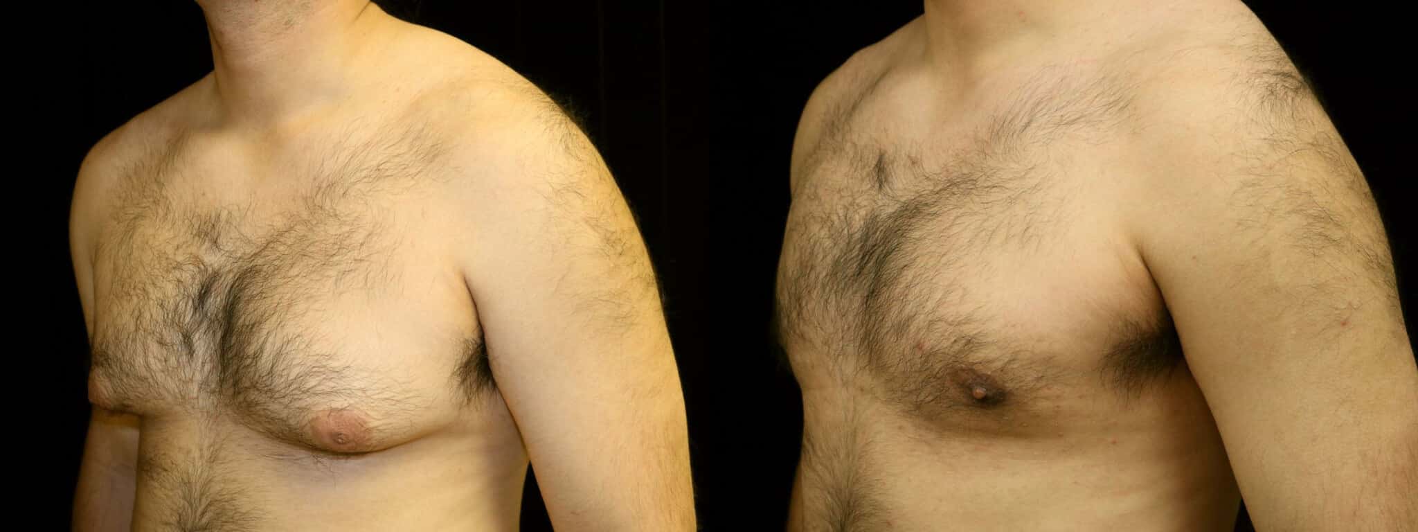 Gynecomastia Patient 6 Before & After Details