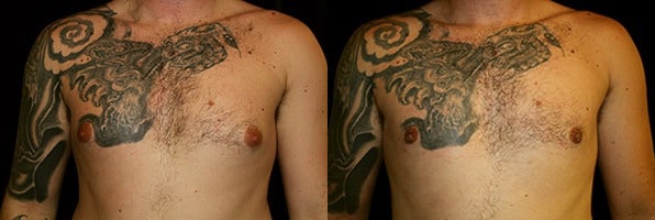 Gynecomastia Patient 1 Before & After