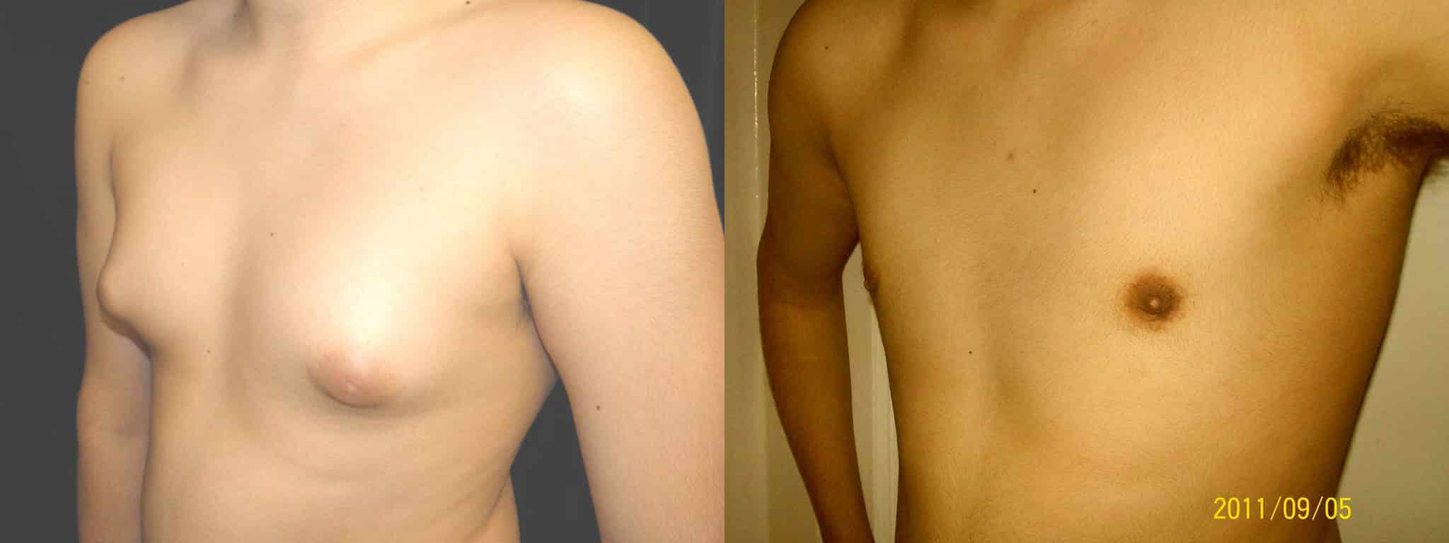 Gynecomastia Patient 14 Before & After Details