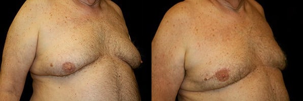 Gynecomastia Patient 19 Before & After Details