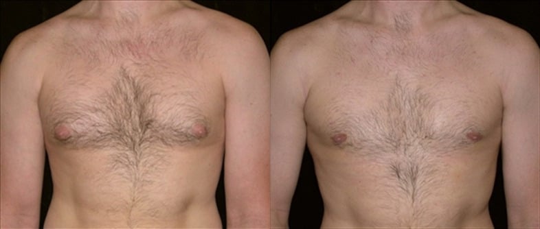 Gynecomastia Patient 9 Before & After