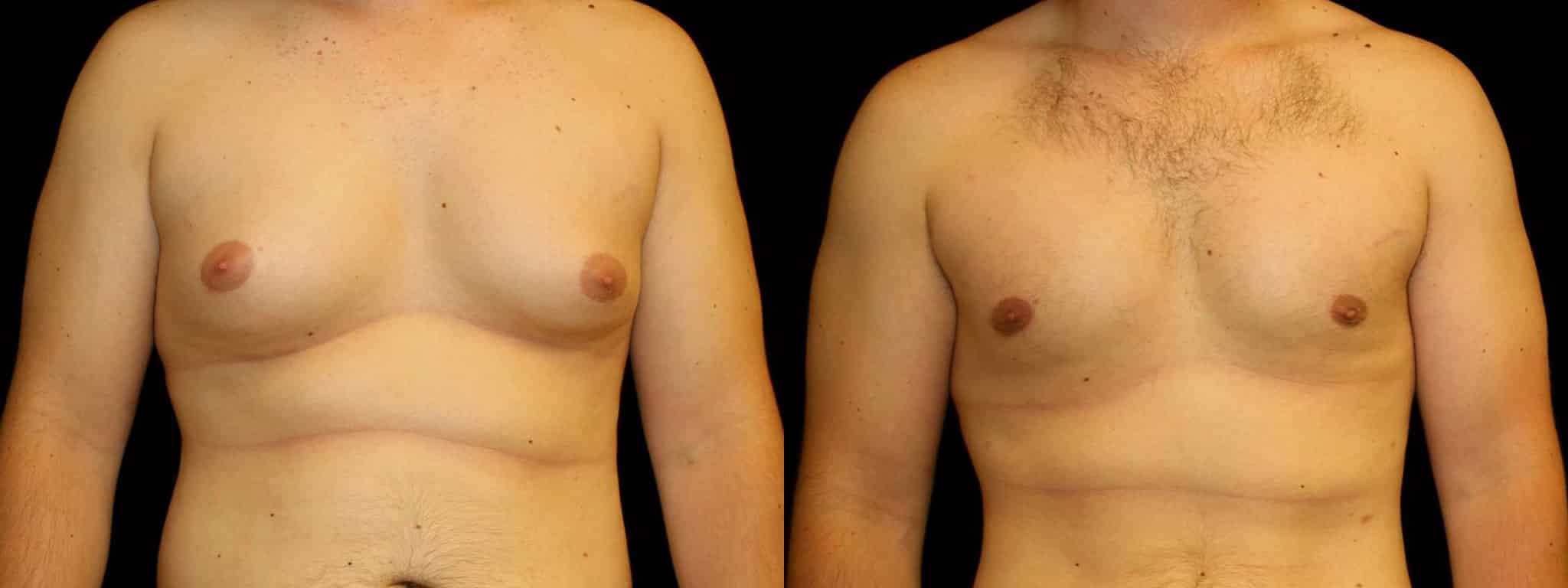 Gynecomastia Patient 3 Before & After