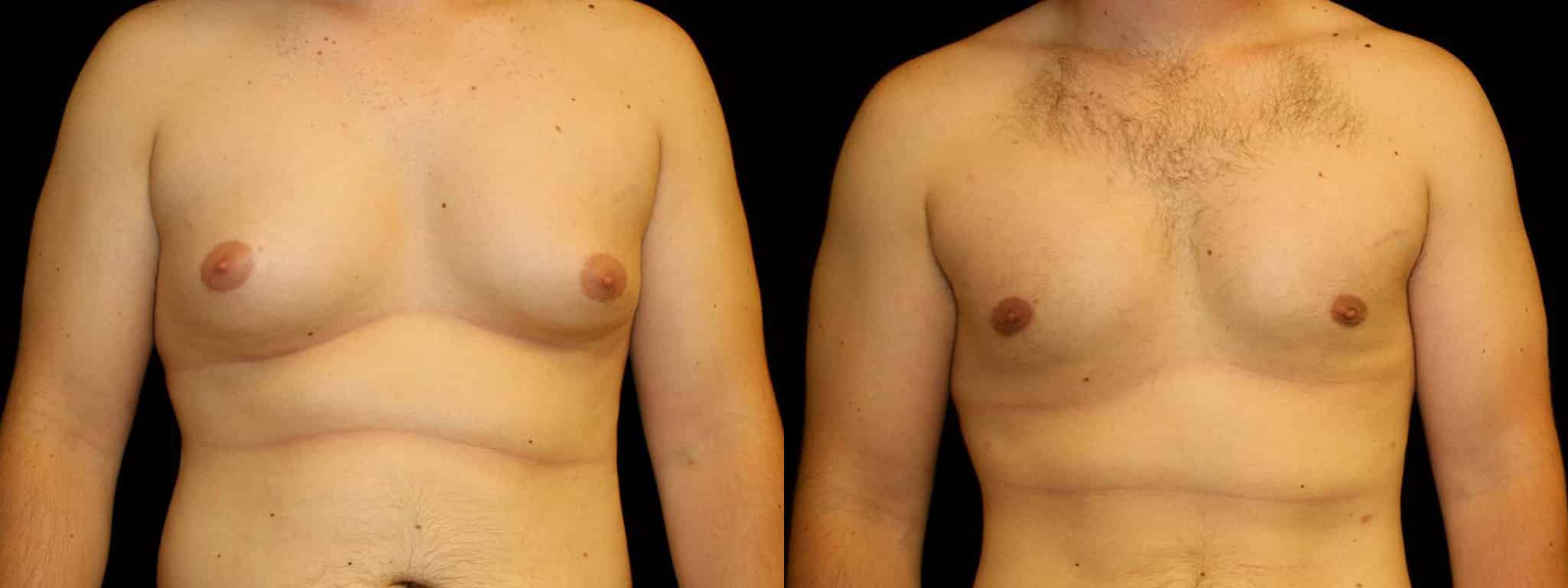 Gynecomastia Patient 3 Before & After Details