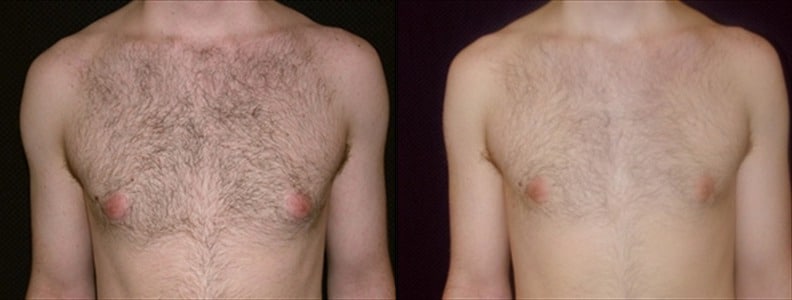 Gynecomastia Patient 15 Before & After