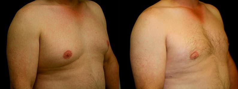 Gynecomastia Patient 5 Before & After Details