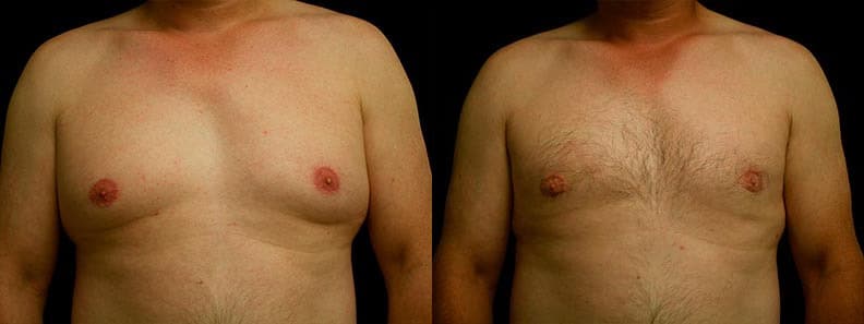 Gynecomastia Patient 5 Before & After