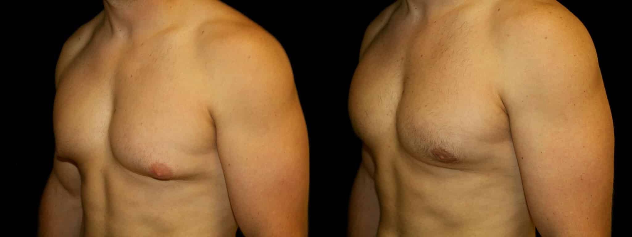 Gynecomastia Patient 13 Before & After Details