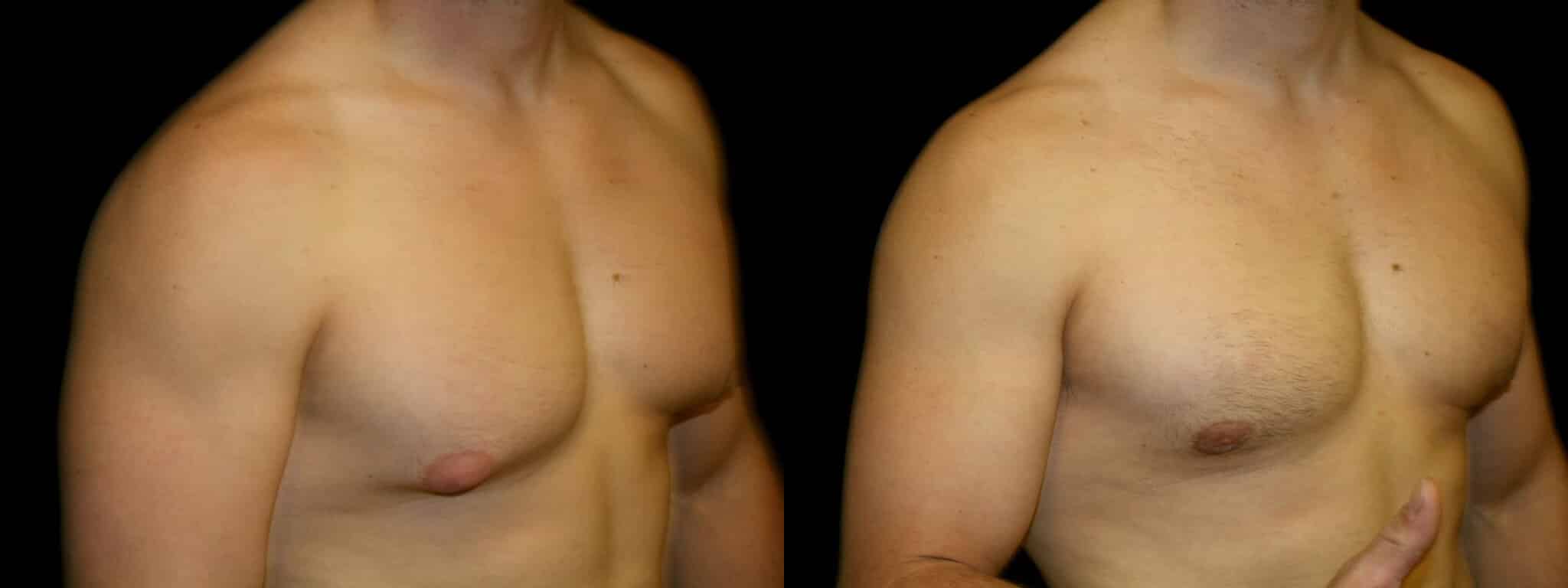 Gynecomastia Patient 13 Before & After Details