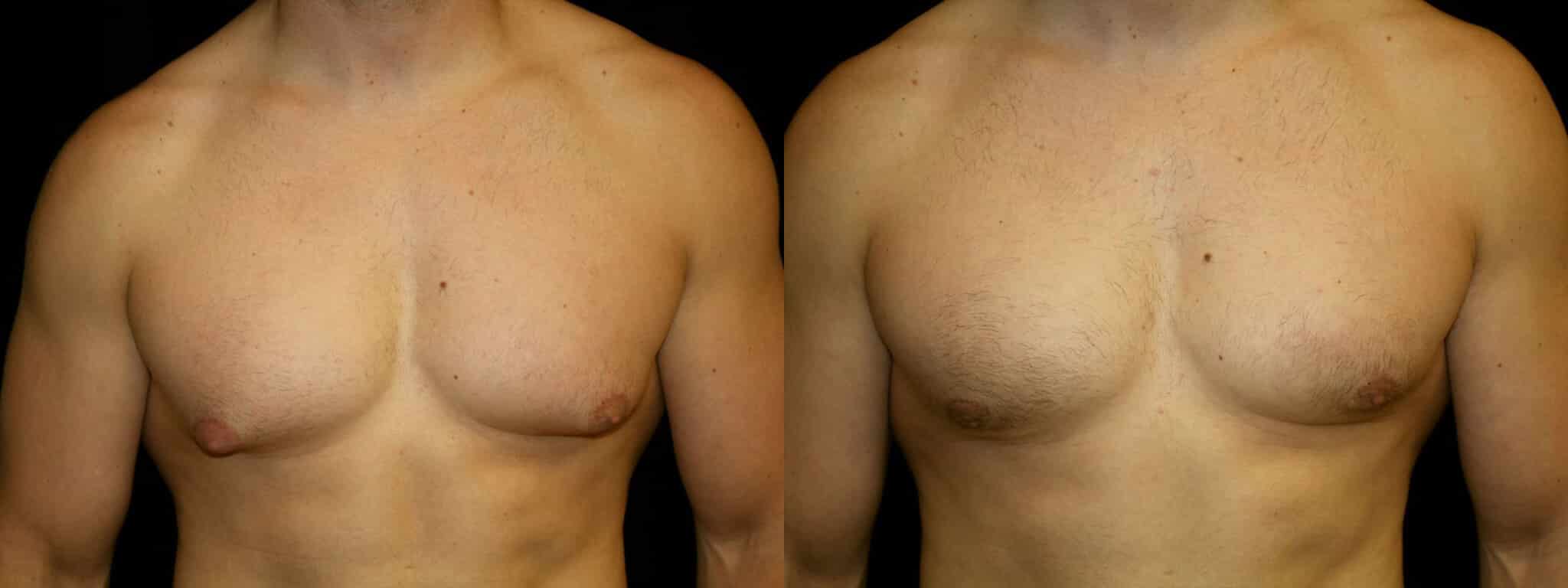 Gynecomastia Patient 13 Before & After