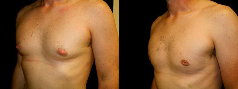 Gynecomastia Patient 9 Before & After Details