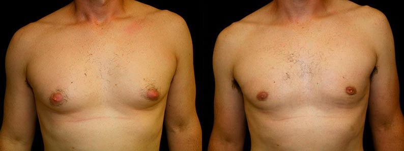 Gynecomastia Patient 9 Before & After