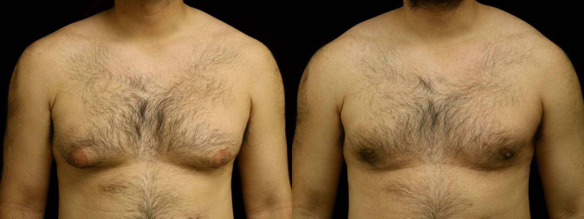 Gynecomastia Patient 6 Before & After