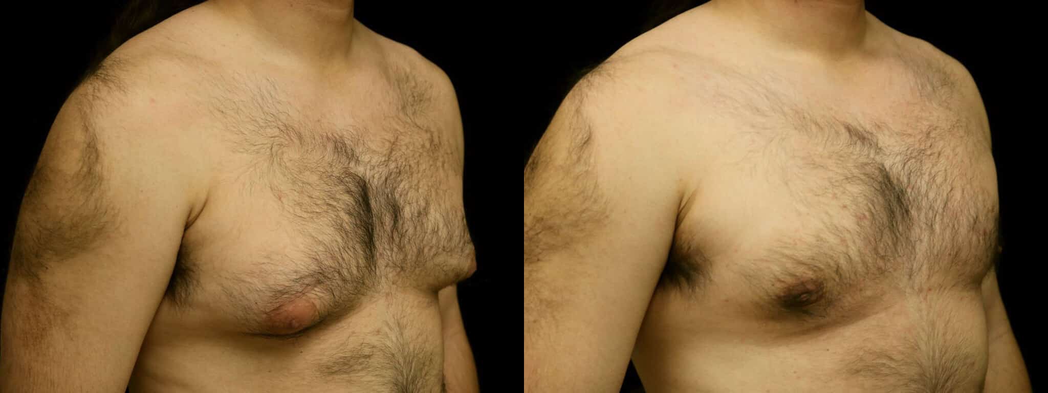 Gynecomastia Patient 6 Before & After Details