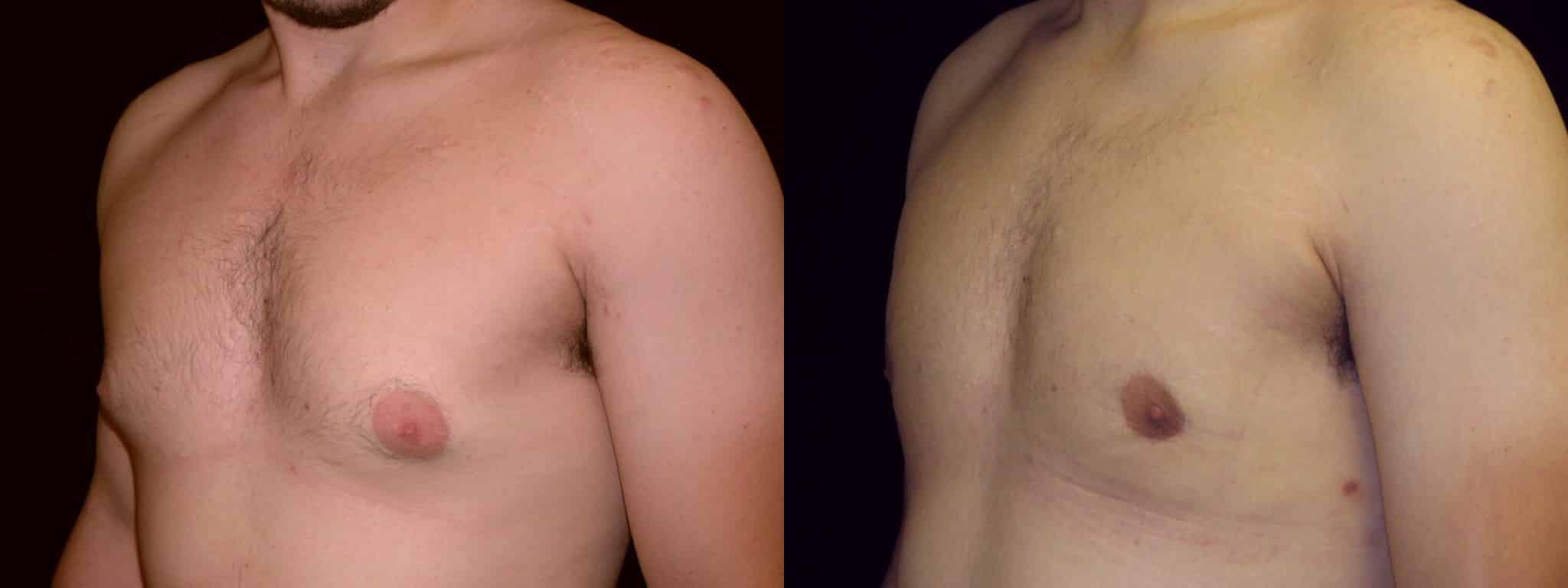 Gynecomastia Patient 13 Before & After Details