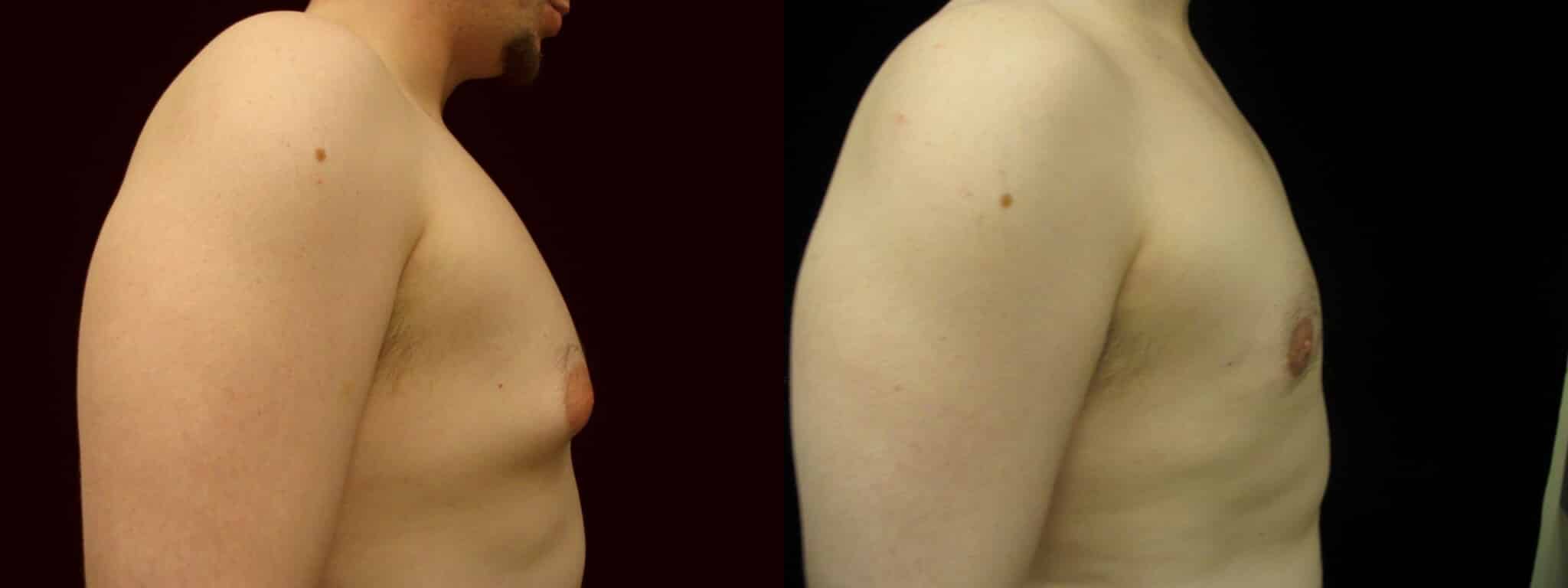 Gynecomastia Patient 7 Before & After Details