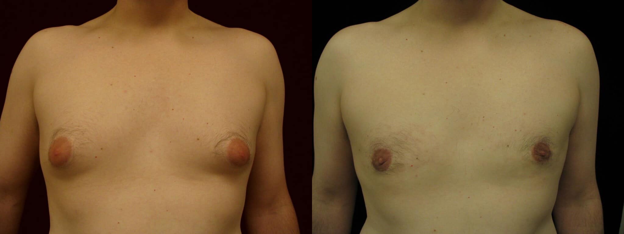 Gynecomastia Patient 7 Before & After