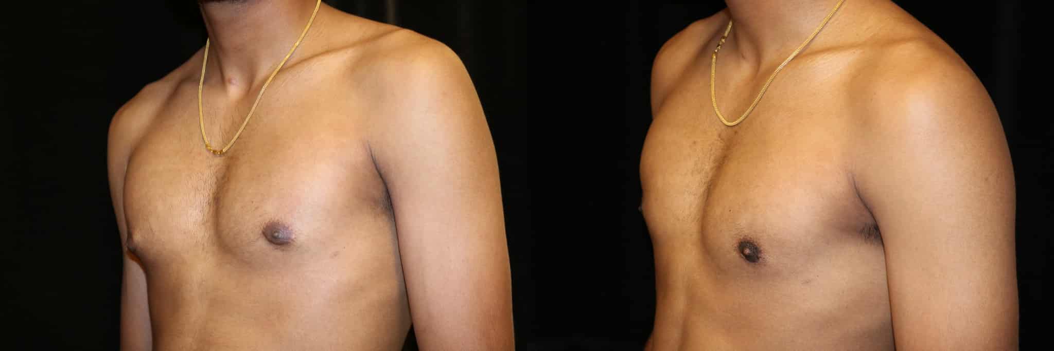 Gynecomastia Patient 12 Before & After Details