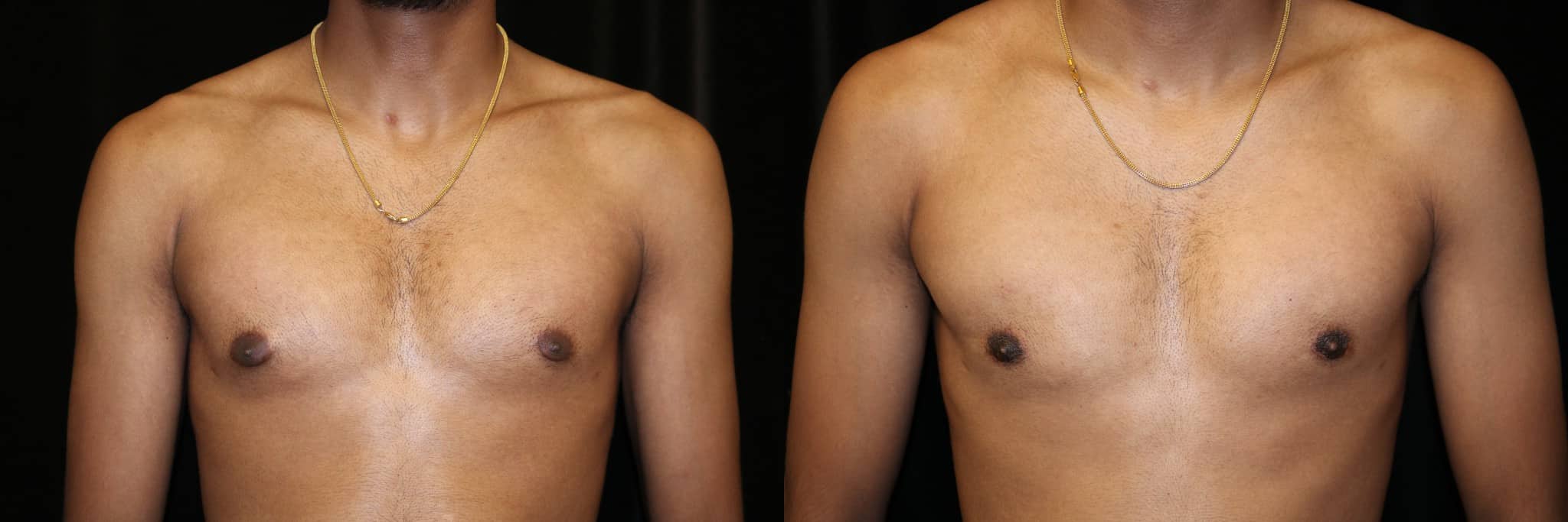 Gynecomastia Patient 12 Before & After