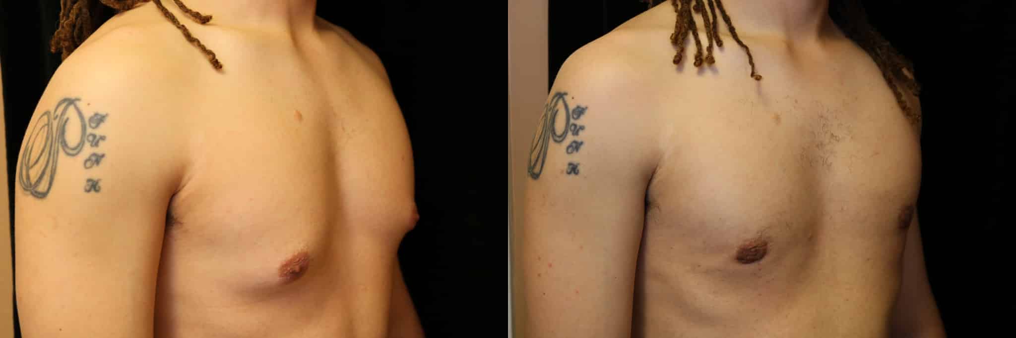 Gynecomastia Patient 5 Before & After Details