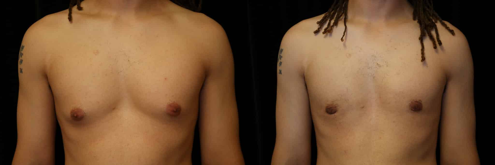 Gynecomastia Patient 5 Before & After