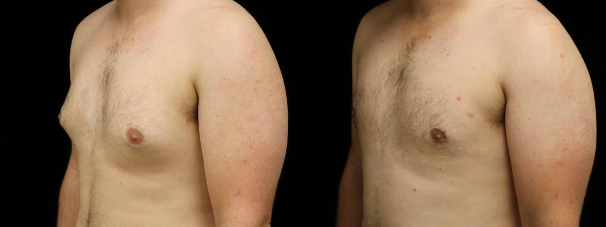 Gynecomastia Patient 16 Before & After Details