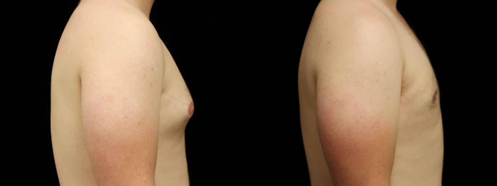 Gynecomastia Patient 16 Before & After Details