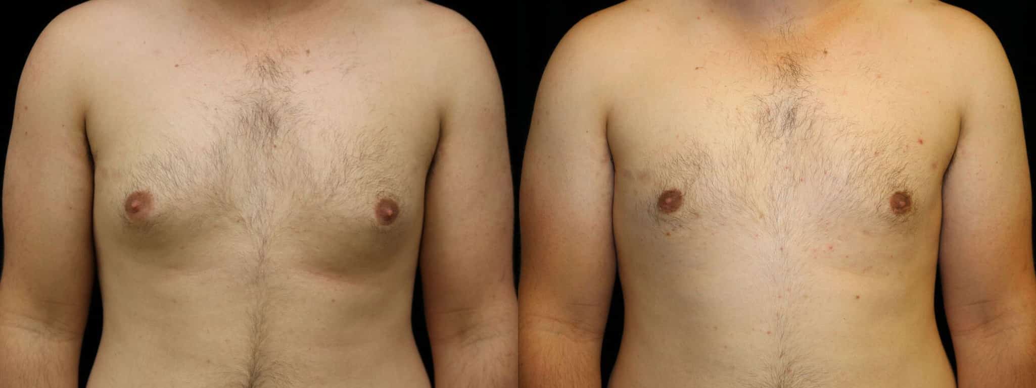 Gynecomastia Patient 16 Before & After