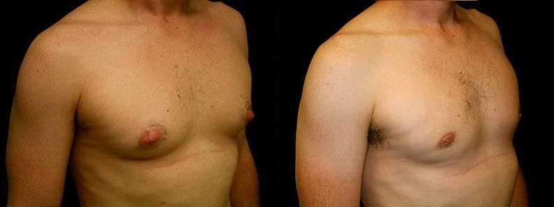 Gynecomastia Patient 9 Before & After Details