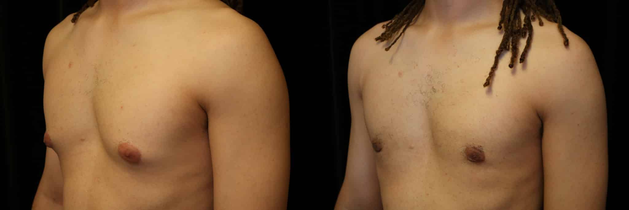 Gynecomastia Patient 5 Before & After Details