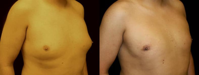 Gynecomastia Patient 7 Before & After Details