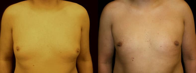 Gynecomastia Patient 7 Before & After