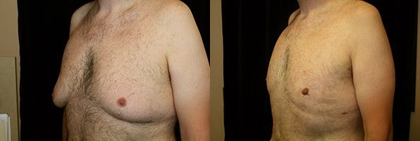 Gynecomastia Patient 20 Before & After Details