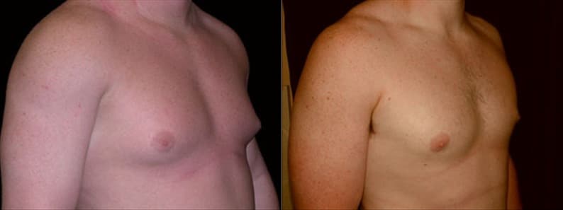 Gynecomastia Patient 3 Before & After Details