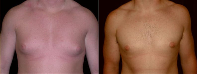 Gynecomastia Patient 3 Before & After