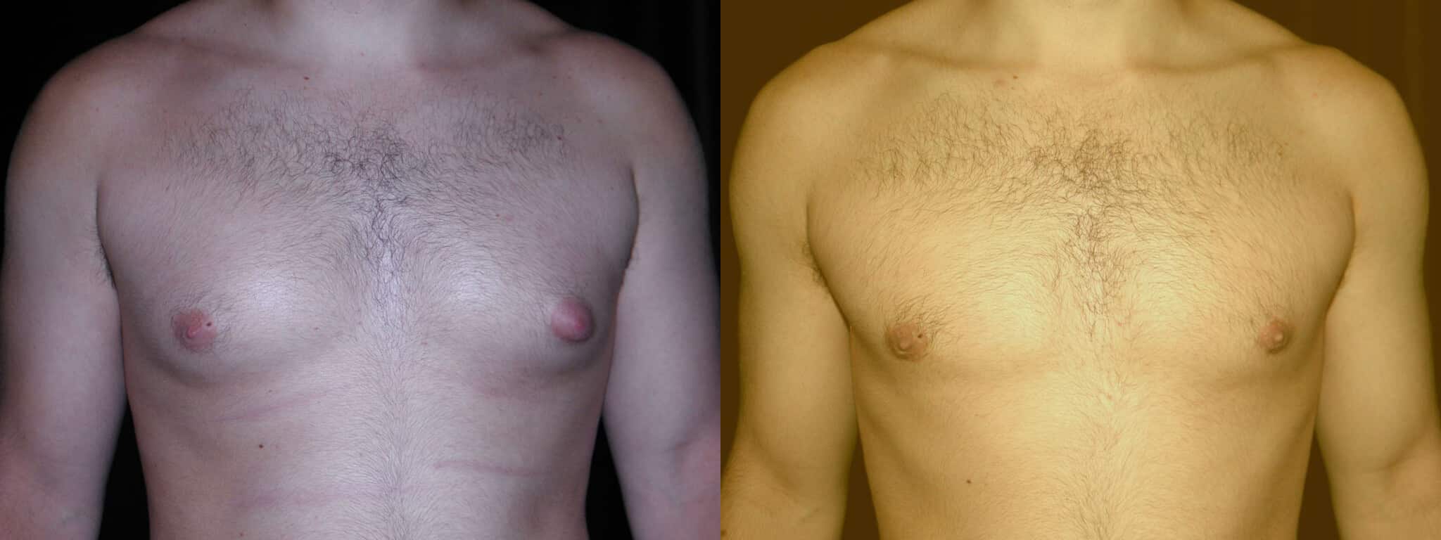 Gynecomastia Patient 12 Before & After