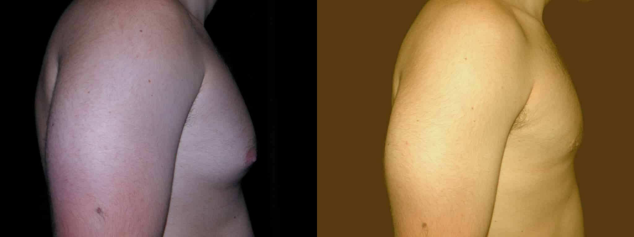 Gynecomastia Patient 12 Before & After Details